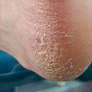 Cracked Skin Treatment in Goa