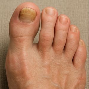 Podiatry Treatment in Bardez, Goa