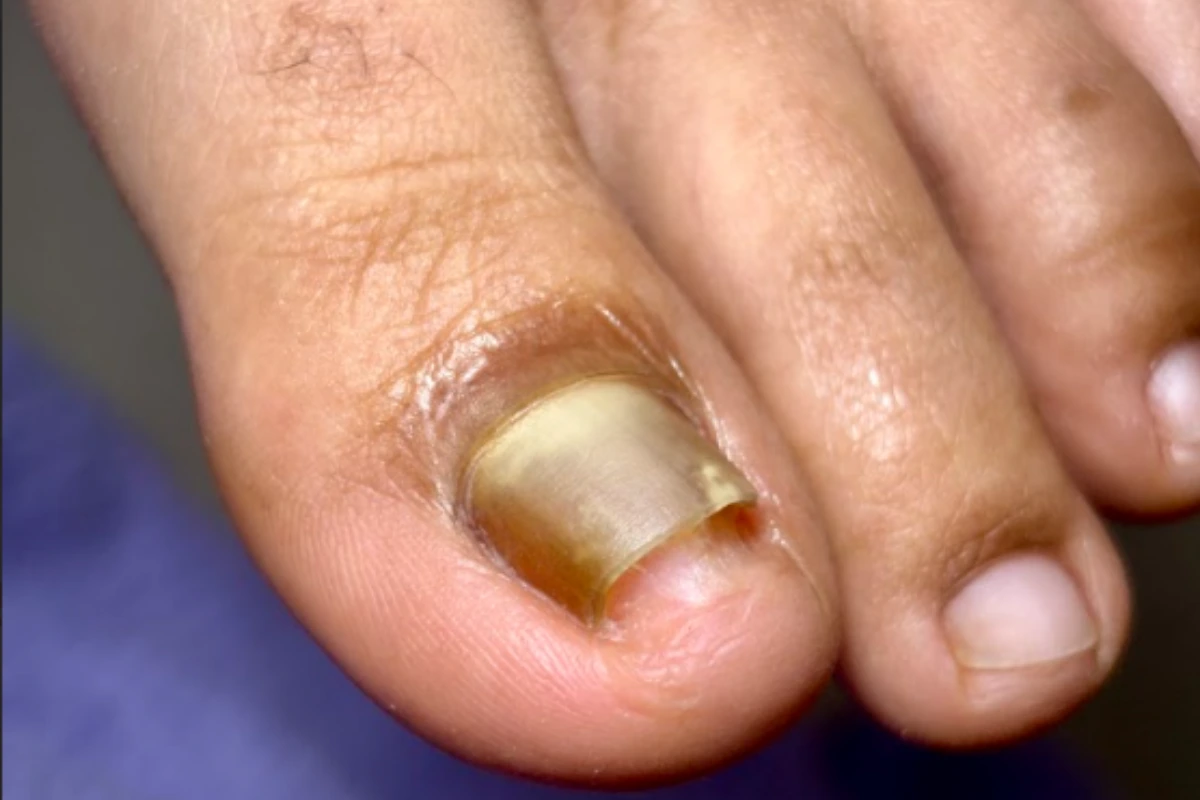 Fungal Nail Treatment